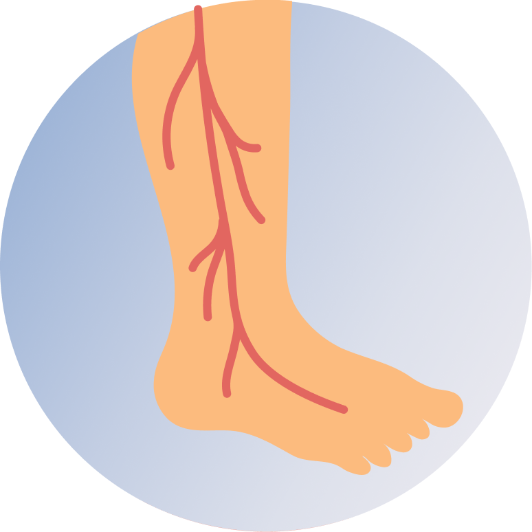 Varicose Vein Treatment