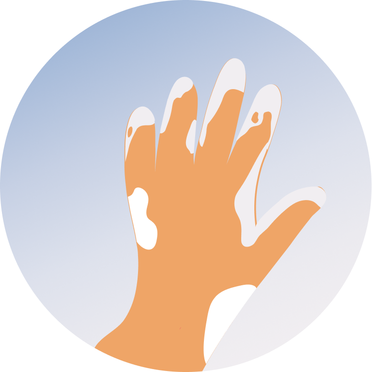 Leucoderma Treatment