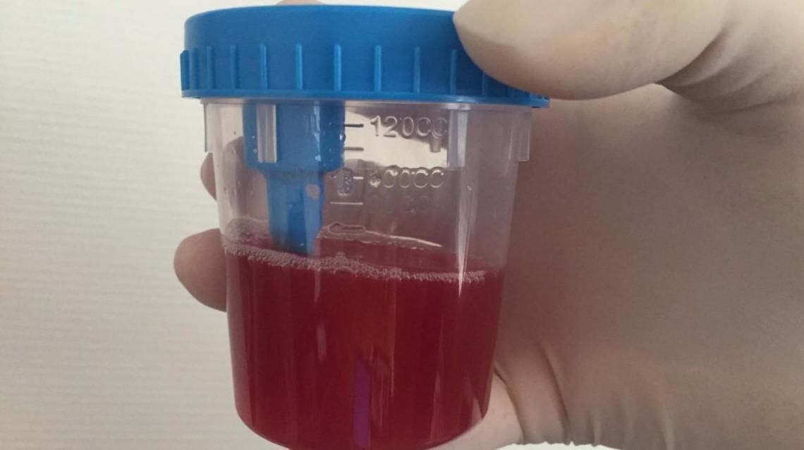 Blood in Urine Can Be Dangerous