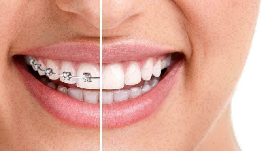 Invisalign vs Metal Braces