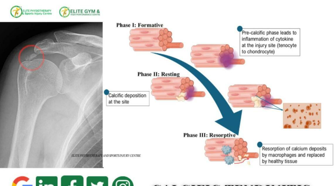 Calcific Tendinitis