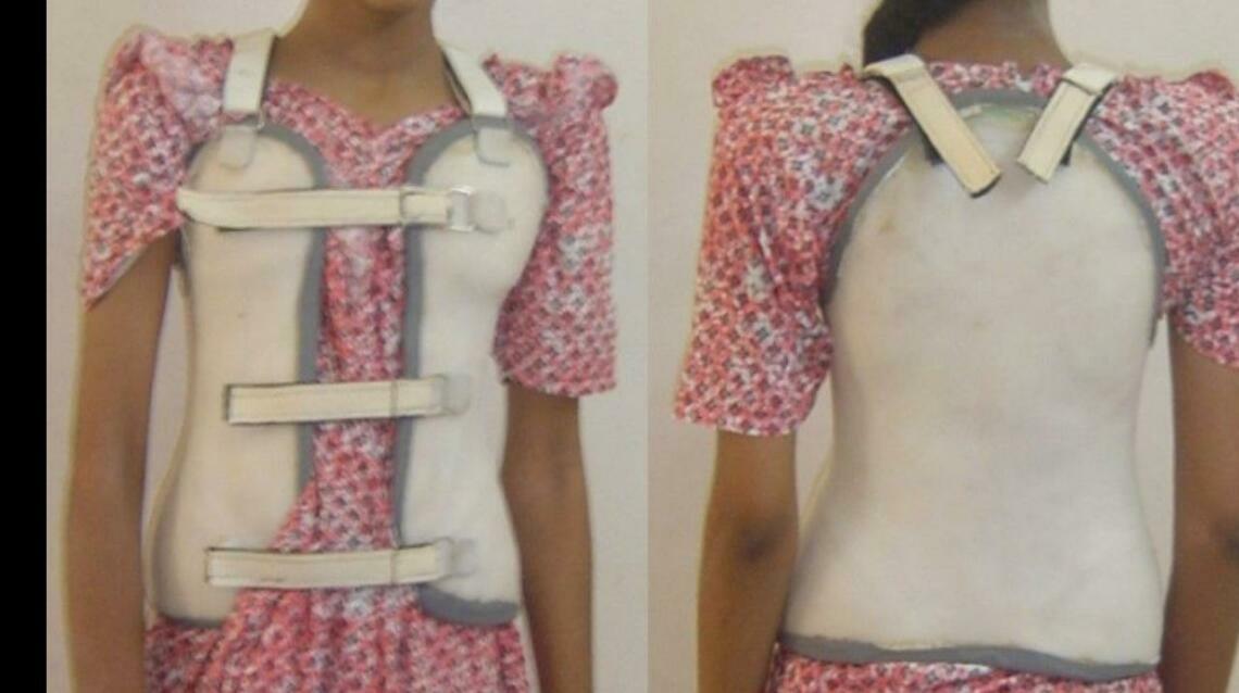 How to Treat Scoliosis Without Surgery?