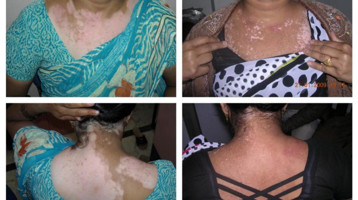 Vitiligo White Patches Skin Itching Hi I Am Diagnosed With