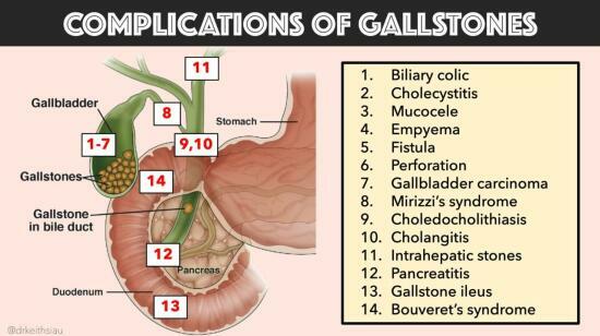 Gallstone Treatment