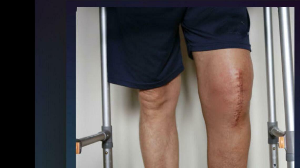 Post Knee Replacement Surgery Rehabilitation