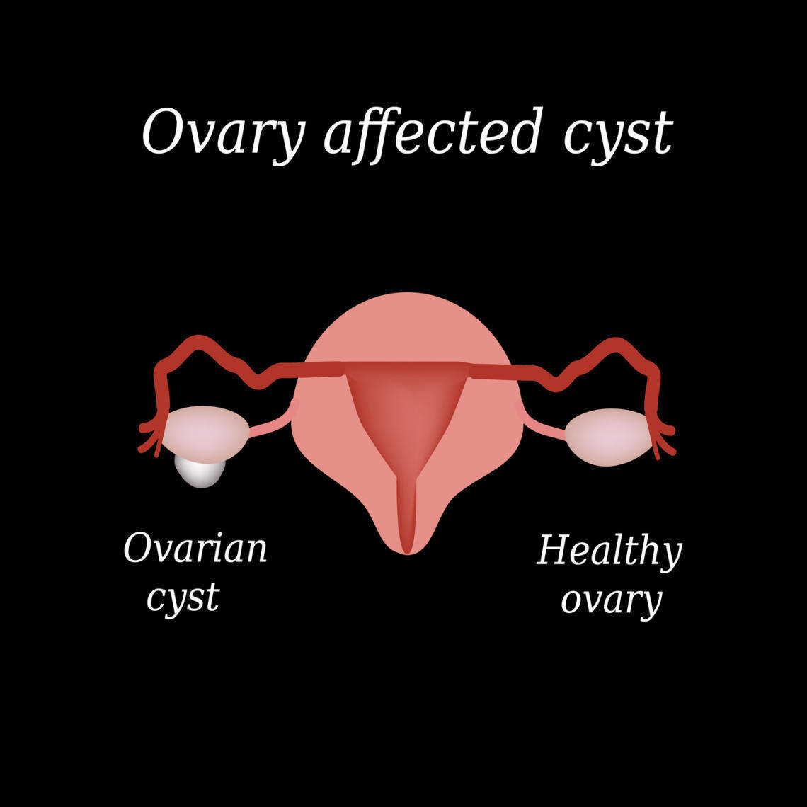 Things You Should Know About Polycystic Ovary Syndrome (Pcos)