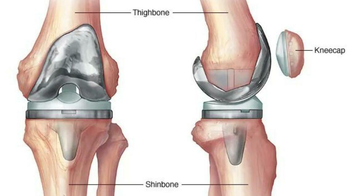 7 Clear Signs You May Need Total Knee Replacement — and Why Delaying Can Make Things Worse
