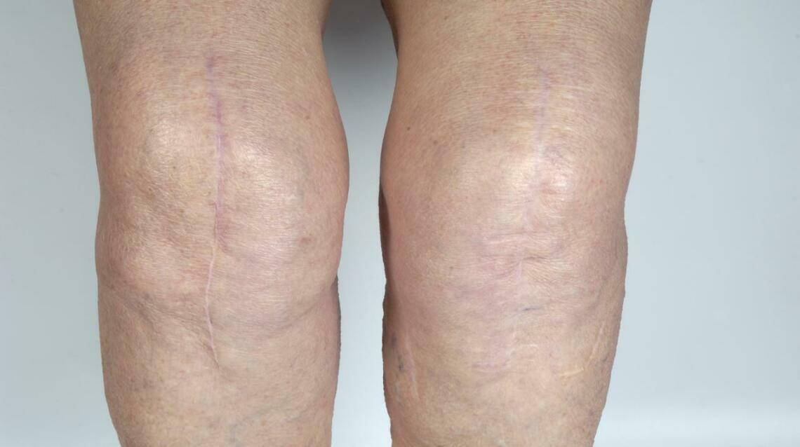 Why Knee Extension Is the Gold Standard After Acl Surgery