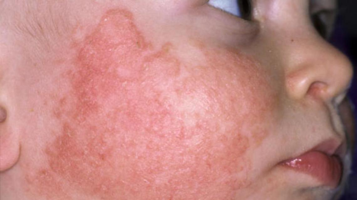 Atopic Dermatitis in Children