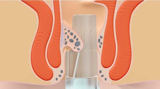 The Rafaelo Procedure