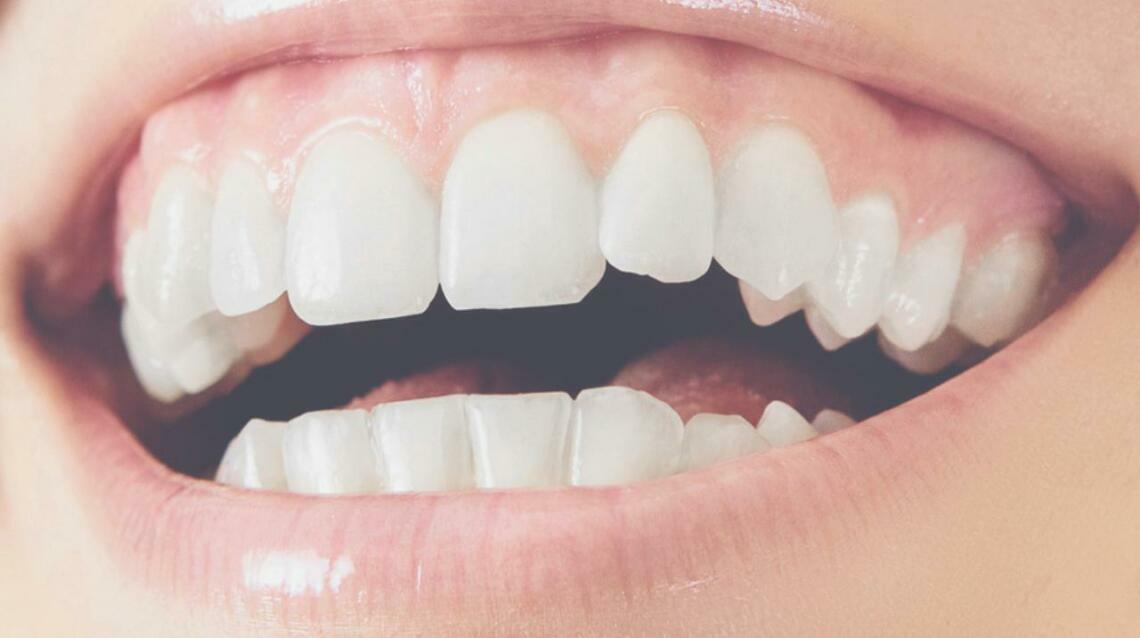 Braces vs Invisible Aligners