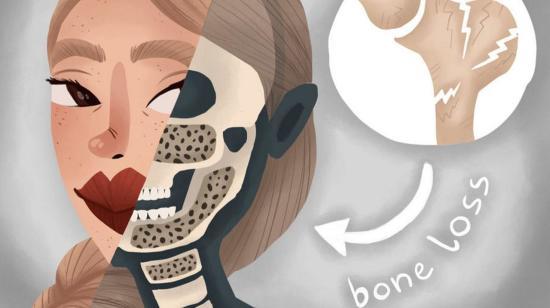 Osteoporosis! Brace Yourself, Before It’s Too Late.