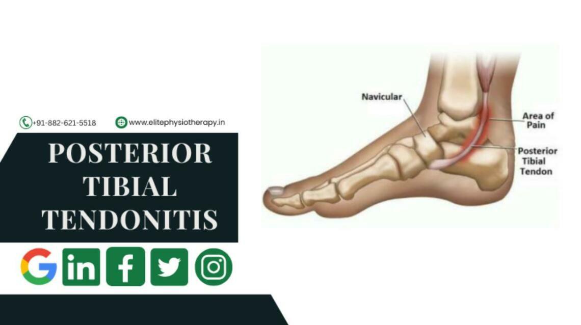 Posterior Tibial Tendonitis