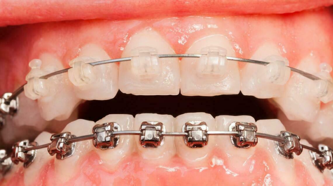 Metal Braces or Ceramic Braces: Which Ones to Choose?