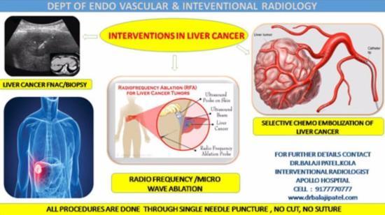 Liver Cancer Can Be Cured With a Small Needle Puncture