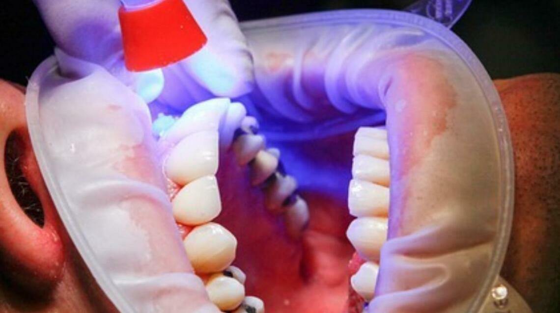 Demystifying Dental Sealants