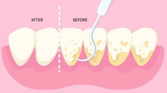 Confused on What to Do After Getting Cleaning of Teeth?