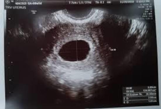 Sac empty tilted ultrasound uterus concerned about