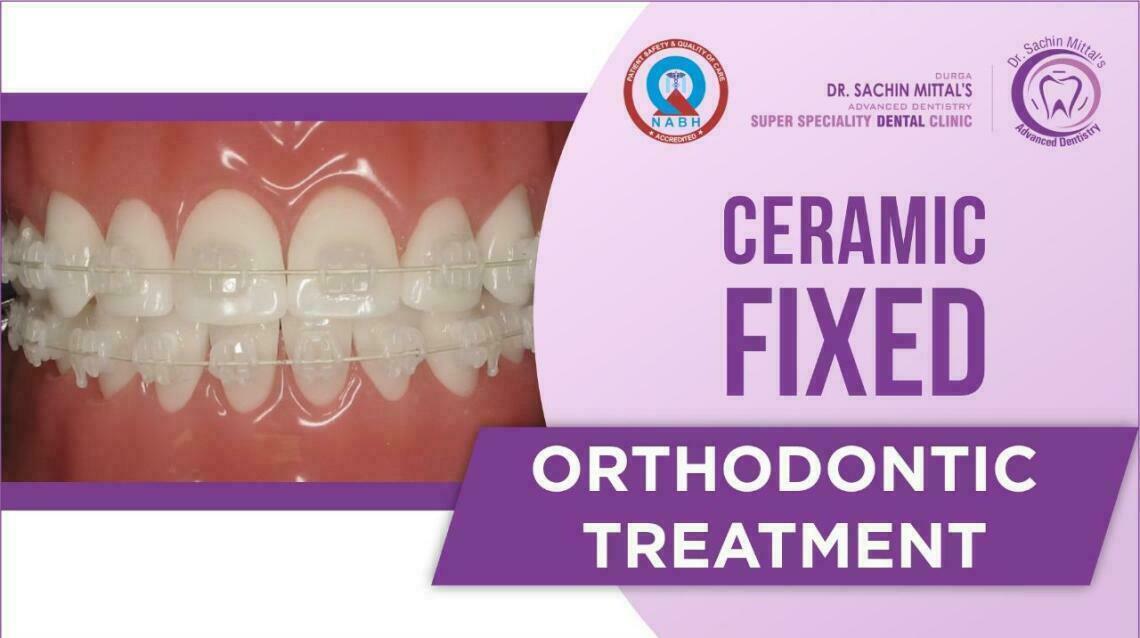 Ceramic Braces Pros and Cons Ceramic Braces Cost in India Ceramic Braces vs Metal Braces