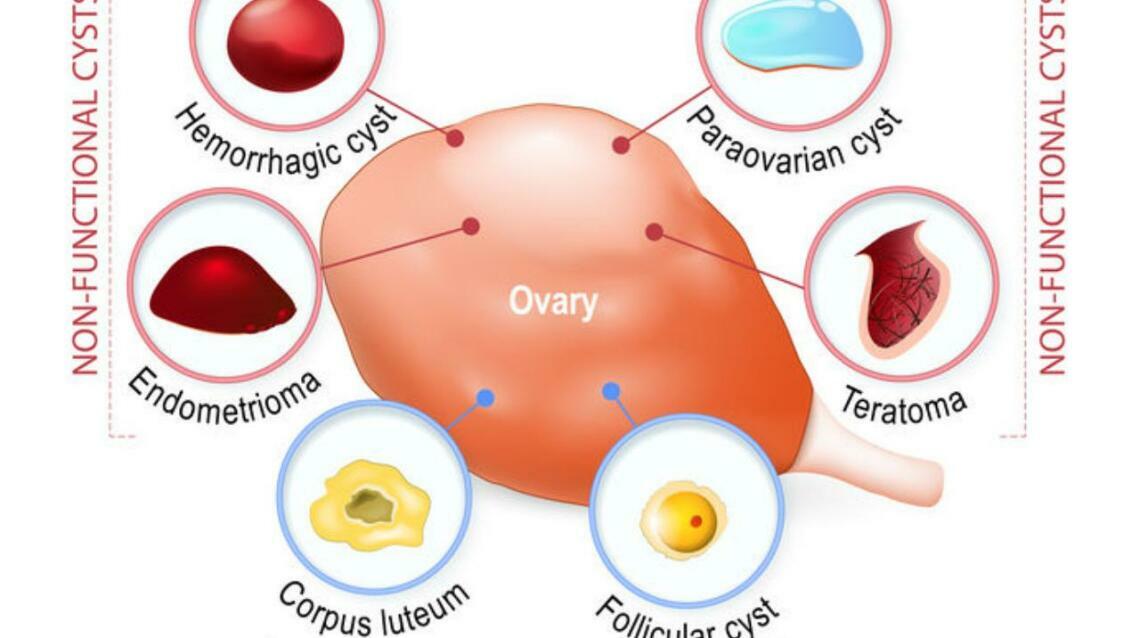 Ovarian Cyst on Ultrasound – What Next?