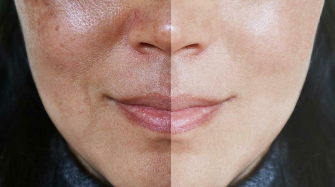 Uneven Skin Tone Explained :Causes, Prevention & Safe Treatments