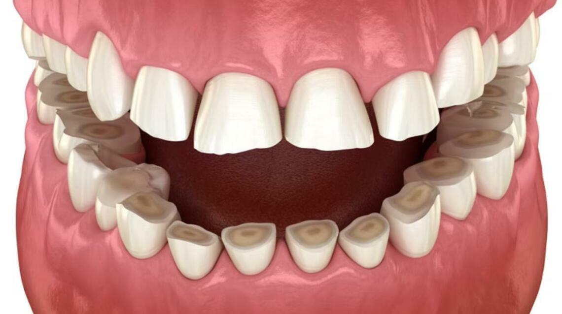 Grinding or Clenching Your Teeth at Night? (Bruxism)