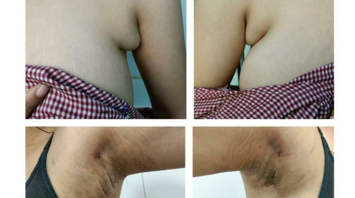 Say Goodbye to Unwanted Axillary Breast Bulge With Scarless Liposuction!