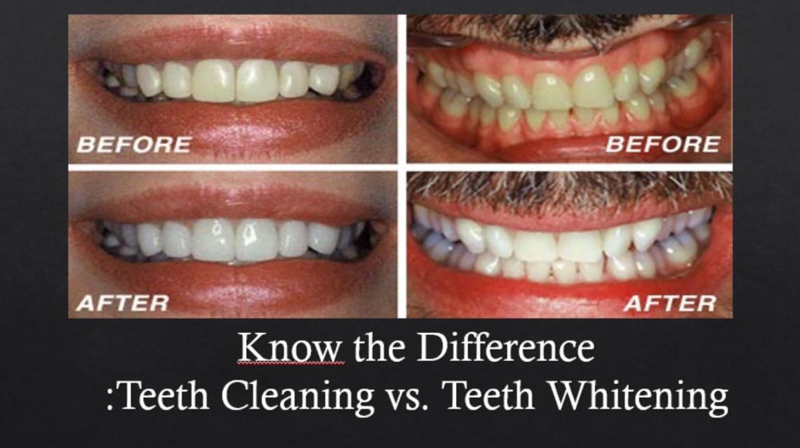 Kn﻿Ow the Difference:teeth Cleaning vs. Teeth Whitening