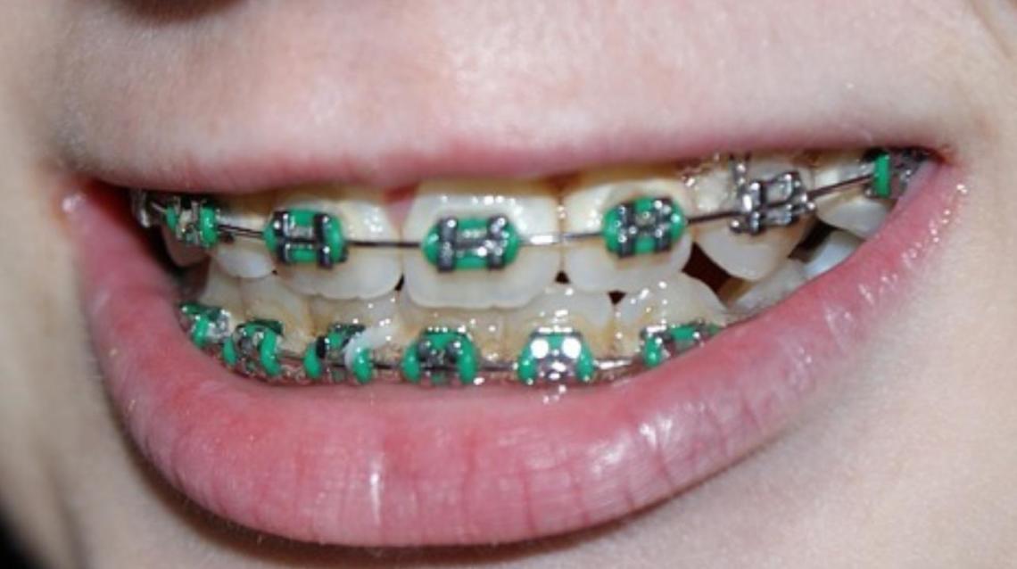 Correct Age for Dental Braces