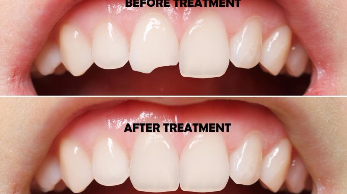 Tooth Contouring & Reshaping