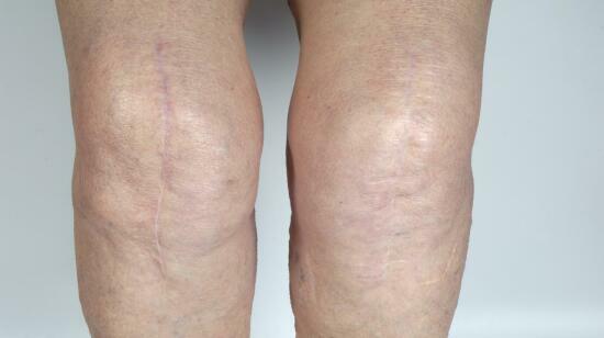 Why Knee Extension Is the Gold Standard After Acl Surgery