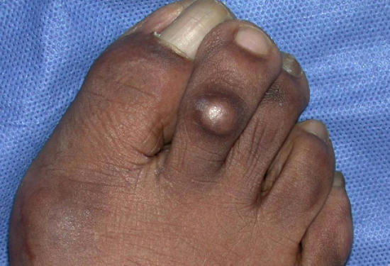 Corn on foot