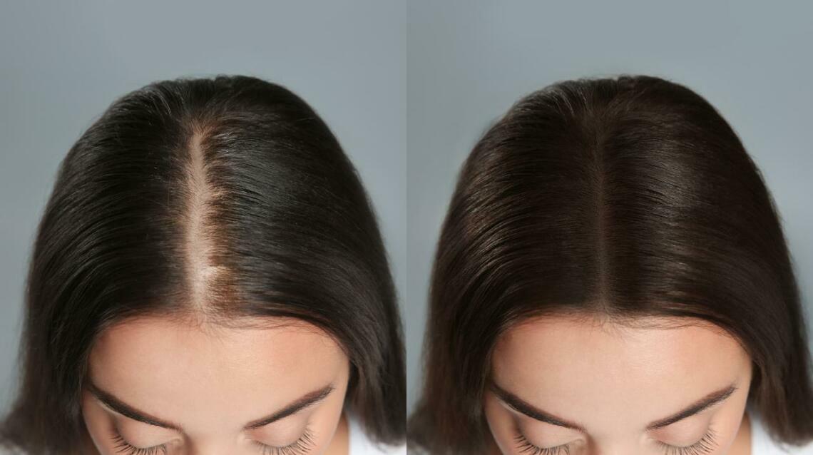 Regenera Activa for Hair Loss: A Revolutionary Autologous Solution for Thinning Hair