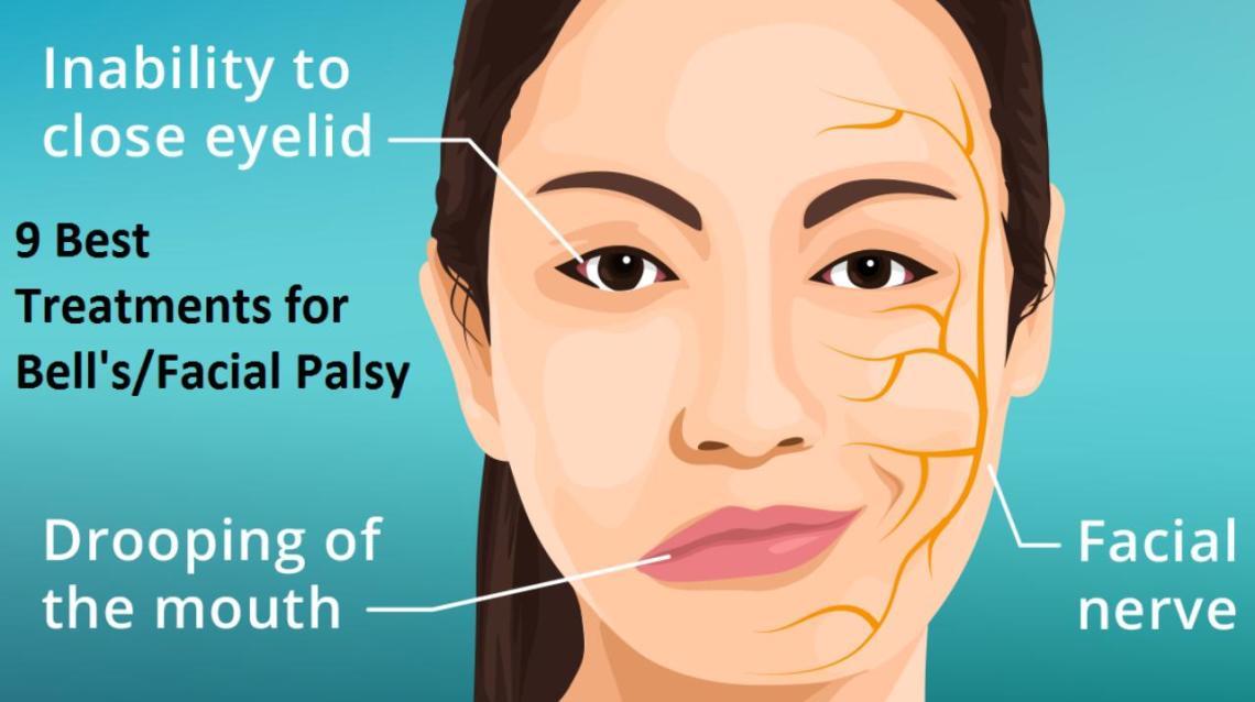 9 Best Treatments for Bell's/facial Palsy