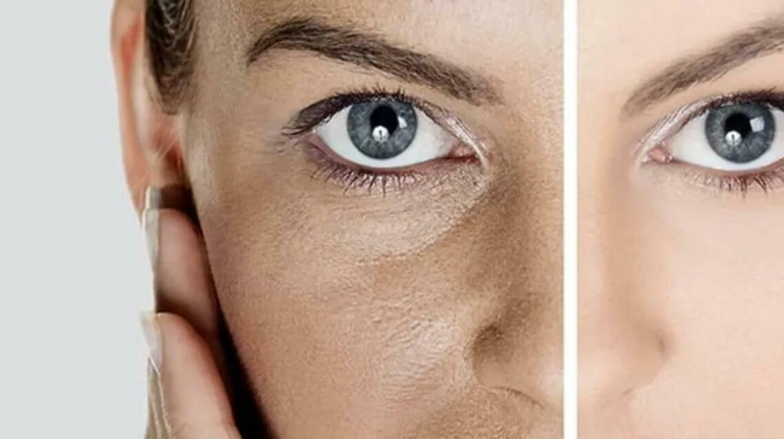 Dull Skin :What Is Really Causing It and How Can Dermatology Treatments Help?