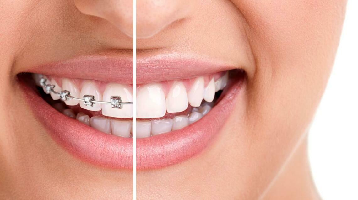 Fixed Braces vs Invisible Braces Advantages and Disadvantages