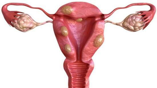 Fibroid on Your Scan Report? 5 Situations Where Surgery May Not Be Needed