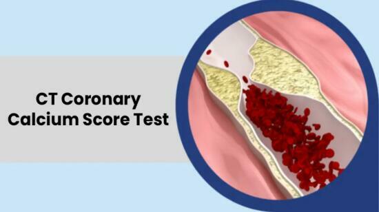 What Is a Ct Coronary Calcium Score Test? When Do You Need It?