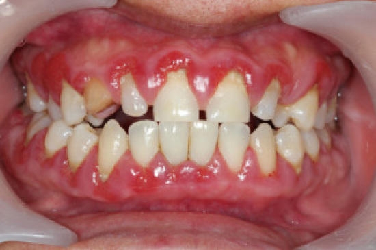 GUMS INFECTION