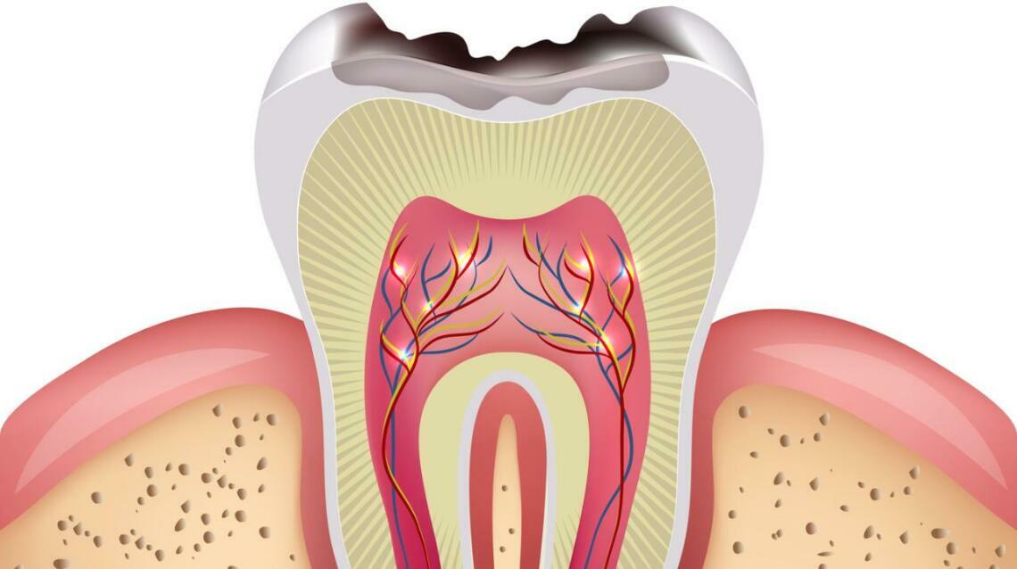 How a Root Canal Saves Your Tooth (And Stops the Pain for Good)