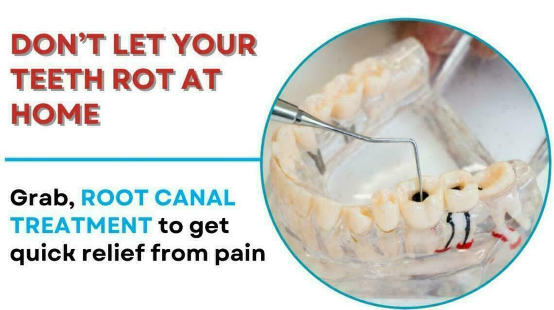 Most Common Myths and Facts About Root Canal Treatment