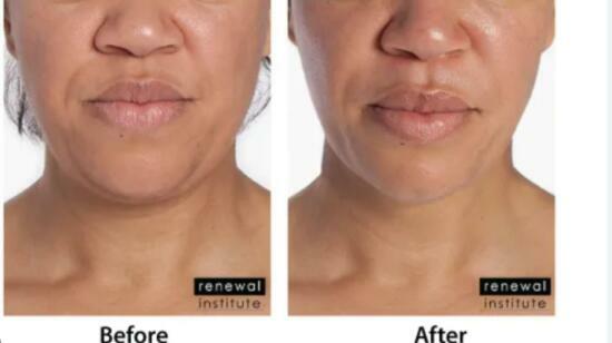 Lipolysis Injections: The Non-Surgical Way to Lose Stubborn Fat