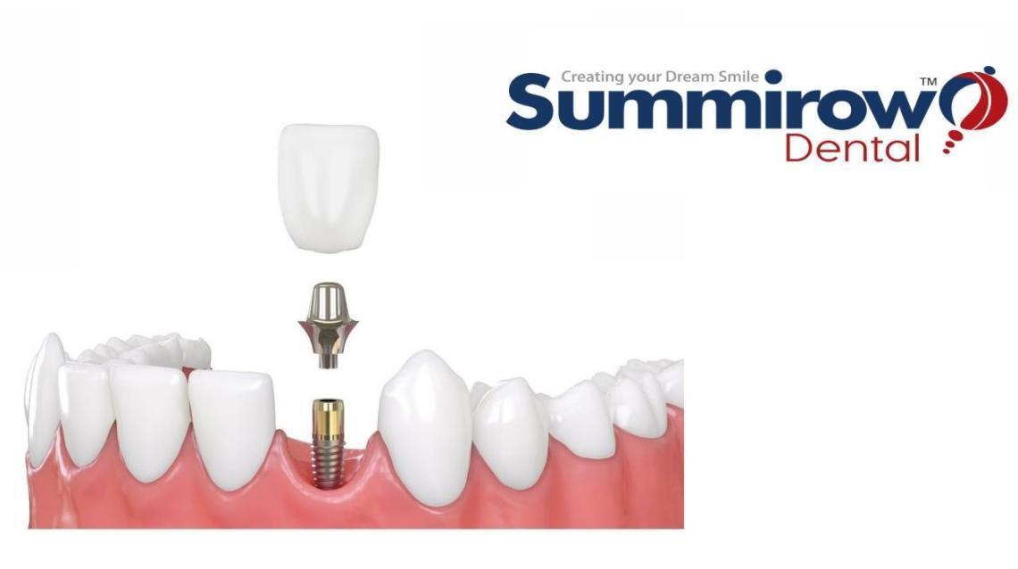 Root Canal Treatment Versus Dental Implants