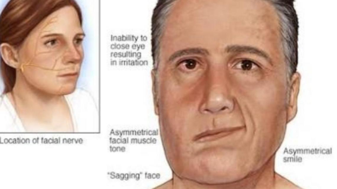 Bell's Palsy