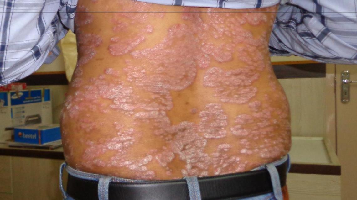 Itching White Dry Patches In Pubic Area I Have Itching White