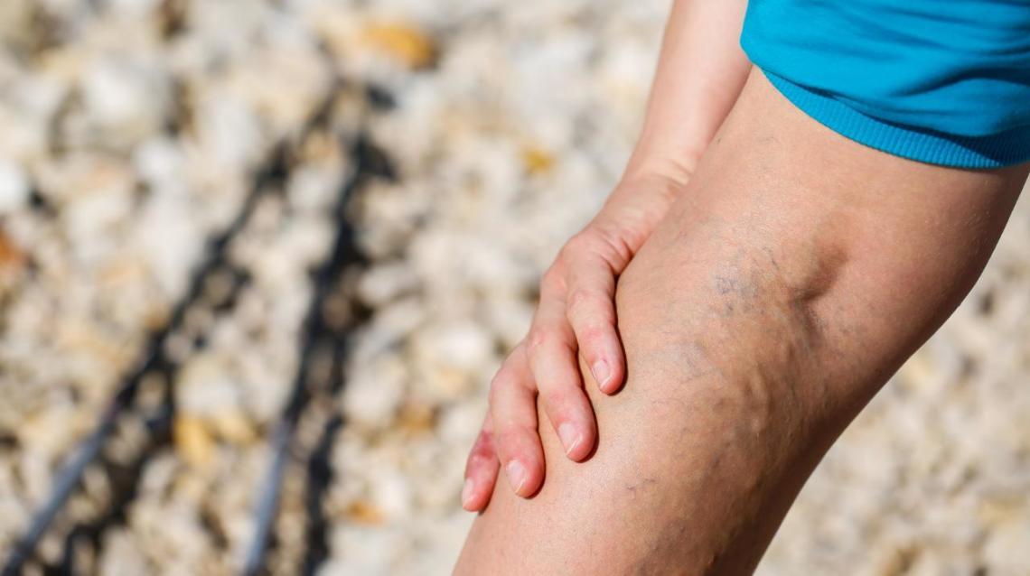 best-home-remedies-to-treat-hamstring-injury