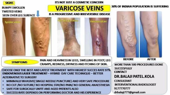 Varicose Veins Disease