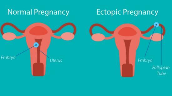 Two Pink Lines Can Turn Into Two Litres of Blood - Early ultrasound.early Diagnosis. Safe Motherhood