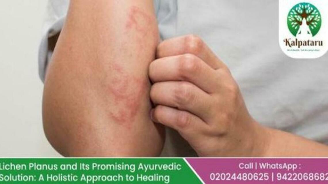 Lichen Planus and Its Promising Ayurvedic Solution A Holistic Approach