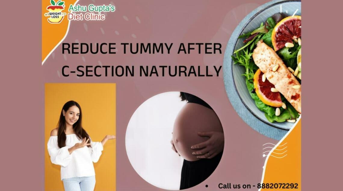 How to Reduce Tummy After C-Section Naturally
